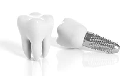 Tooth and dental implant 