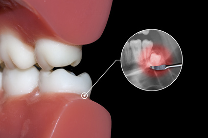 wisdom teeth